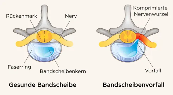 Vergleich gesunde Bandscheibe vs. Bandscheibenvorfall. Ein Vorfall drückt auf Nerven, was zu quälenden Bandscheibenvorfall Schmerzen gehen nicht weg führen kann.
