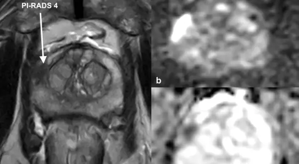 MRT Prostata Befund verstehen: Bild a zeigt eine Läsion mit PI-RADS 4. Bilder b und c zeigen die Diffusionsbildgebung, die bei der Interpretation hilft.