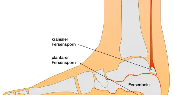 Schematische Darstellung der Calcaneus Anatomie mit Fersensporn (kranial und plantar) und dem Fersenbein.