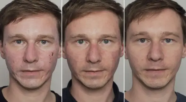 Jak przyspieszyć gojenie po laserze frakcyjnym? Skuteczne porady