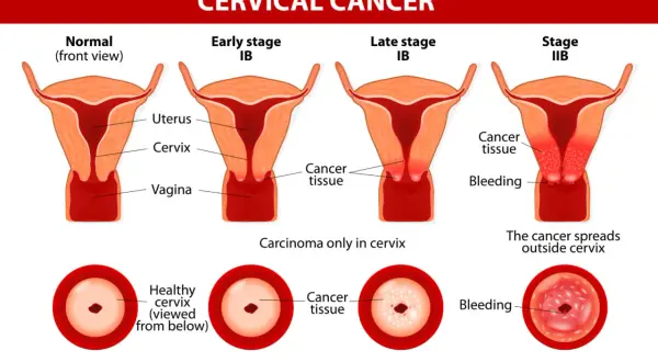 Grafika pokazuje rozwój raka szyjki macicy, od normalnego stanu do zaawansowanego. Warto wiedzieć, hpv co to jest, bo to główna przyczyna tej choroby.