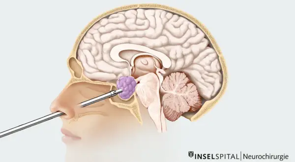 Chirurgischer Eingriff durch die Nase zur Entfernung eines Hypophysentumors.