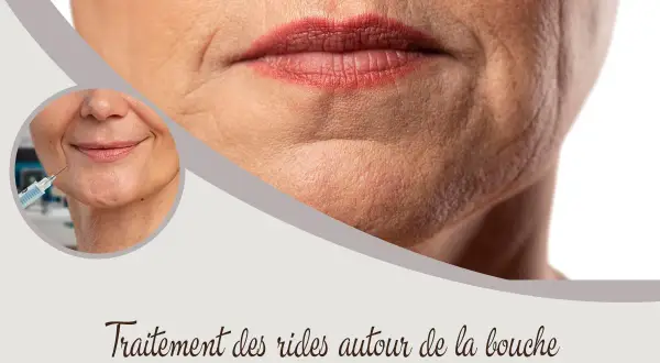 Traitement des rides autour de la bouche : une injection pour un visage plus lisse.