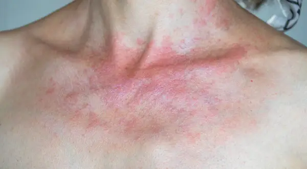 Rote, juckende Haut am Dekolleté und Hals, ein Zeichen für Sonnenallergie. Vorbeugen ist wichtig.