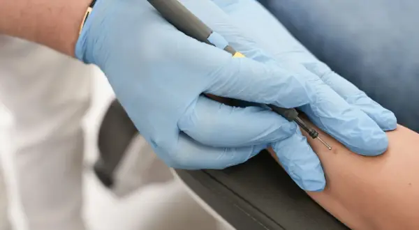 Zabieg elektrokoagulacji kurzajek na przedramieniu. Dłoń w niebieskiej rękawiczce trzyma elektrokoagulator.