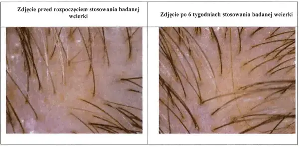 Co daje masaż głowy? Odkryj sekrety zdrowych włosów i relaksu