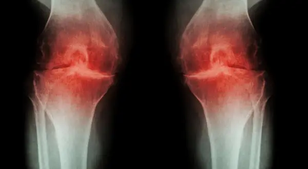 RTG kolan z zaznaczonymi zmianami zapalnymi. Widoczne zwężenie przestrzeni stawowych, sugerujące chorobę zwyrodnieniową, która może wymagać osteotomii.