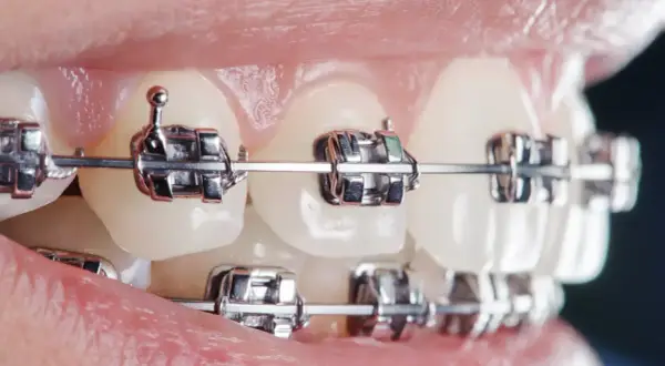 Zbliżenie na zęby z aparatem ortodontycznym. Metalowe zamki i łuk widoczne na zębach, świadczące o leczeniu u dentysty.