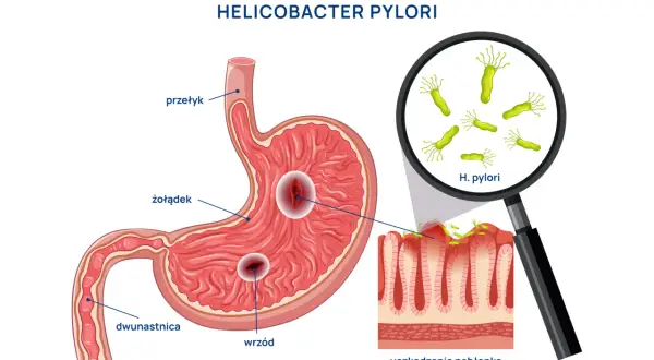 Bakteria Helicobacter pylori powoduje wrzody żołądka i dwunastnicy, uszkadzając nabłonek.