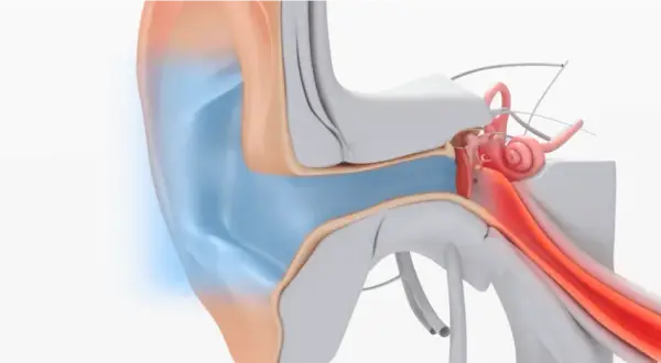Illustration av örats anatomi, visar hur man kan ta bort vaxpropp för att återställa hörseln.