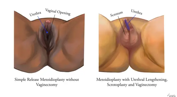 Comparaison de deux procédures chirurgicales pour transformer un pied mâle en femelle : la métoidioplastie simple et la métoidioplastie avec allongement urétral, scrotoplastie et vaginectomie.