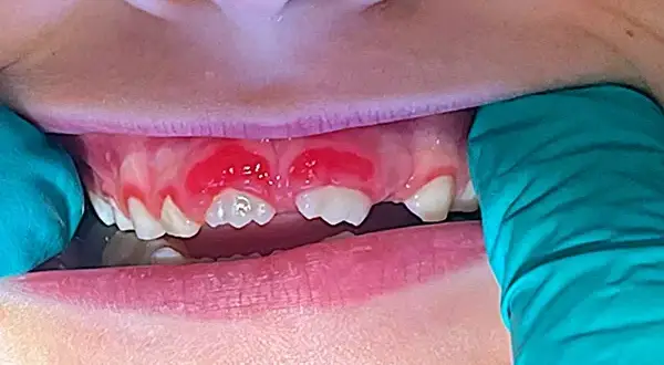 Zapalenie dziąseł u dziecka: Objawy, leczenie, kiedy do dentysty?