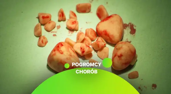 Kamienie w pęcherzu moczowym, usunięte podczas zabiegu.