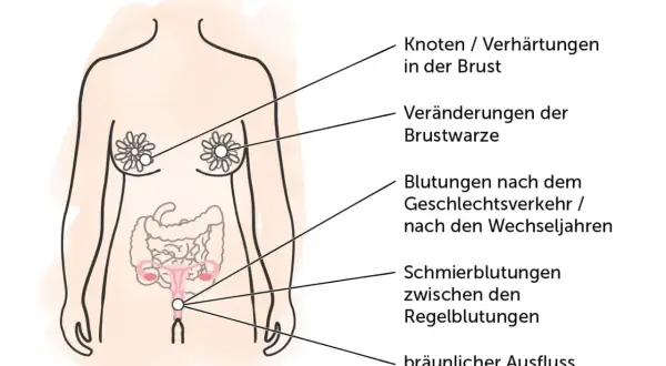 Illustration zeigt, wie ein Tumor aussehen kann: Knoten in der Brust, Veränderungen der Brustwarze, Blutungen, Schmierblutungen und bräunlicher Ausfluss.