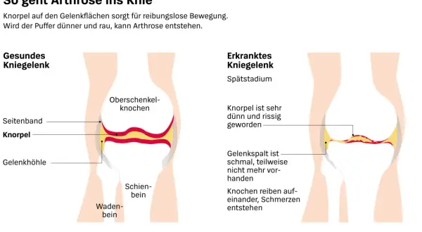 Vergleich von gesundem und arthrosekrankem Kniegelenk. Die Darstellung zeigt, wie Knorpelverschleiß zu Schmerzen führt – eine mögliche "wunderwaffe gegen arthrose knie" wäre hier wünschenswert.