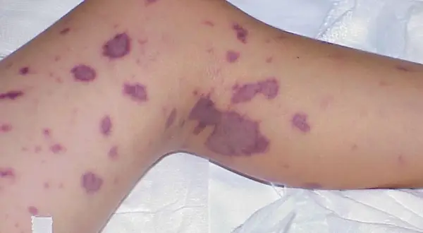 Piel con manchas moradas, un posible síntoma de meningitis.