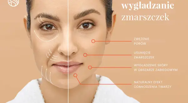 Kobieta z widocznymi zmarszczkami mimicznymi po jednej stronie twarzy, po drugiej gładka skóra. Wskazania zabiegu: wygładzanie zmarszczek.