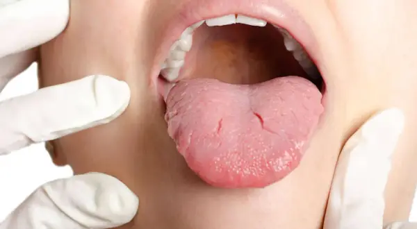 Arzt untersucht Zunge auf mögliche zungenkrebs symptome. Die Zunge ist herausgestreckt, die Lippen geöffnet.