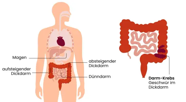 Illustration zeigt den menschlichen Verdauungstrakt mit einem hervorgehobenen Bereich, der Darmkrebs und Geschwüre im Dickdarm darstellt. Frühzeitige Erkennung von Darmkrebs Symptomen ist wichtig.