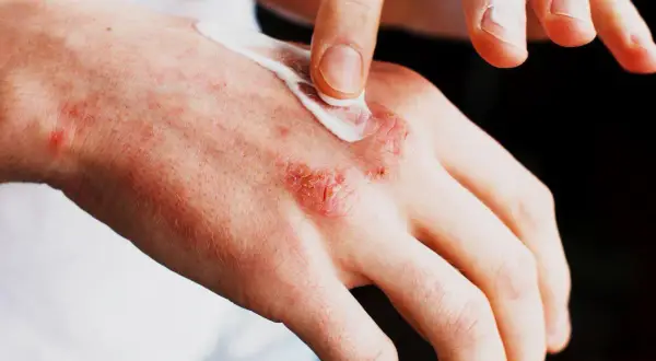 Alergia na sierść objawy skórne – jak je rozpoznać i leczyć