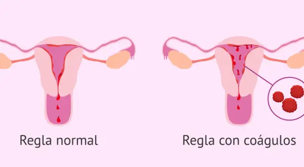 Comparación de úteros: uno muestra regla normal, el otro regla con coágulos. El embarazo y los coágulos menstruales son temas importantes.