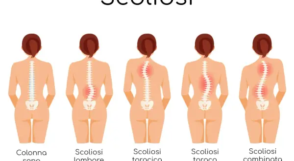 Illustrazione dei diversi tipi di scoliosi e dei relativi sintomi: colonna sana, scoliosi lombare, toracica, toraco-lombare e combinata.