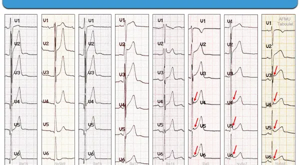 Variantes masculines/précoces : plusieurs tracés ECG montrant des variations de l'onde R et du segment ST, avec une transition précoce possible. Un ECG normal peut présenter ces caractéristiques.