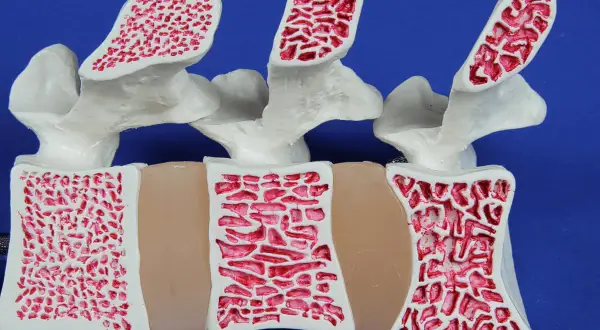 Model kręgosłupa z widoczną strukturą kości. Po lewej kość zdrowa, po prawej widoczne ubytki świadczące o osteoporozie.