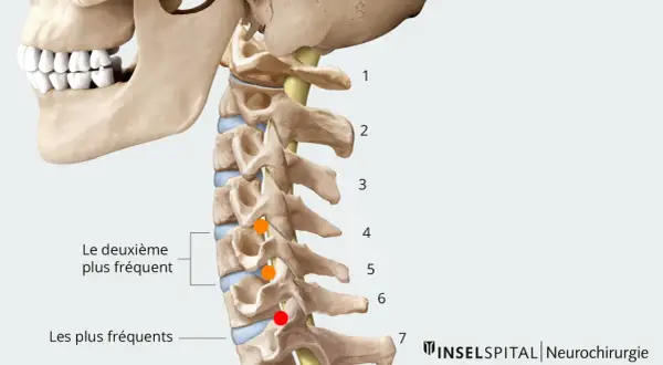 Anatomie du rachis cervical, montrant les localisations des hernies discales. Le temps de guérison d'une hernie cervicale dépend de sa gravité.