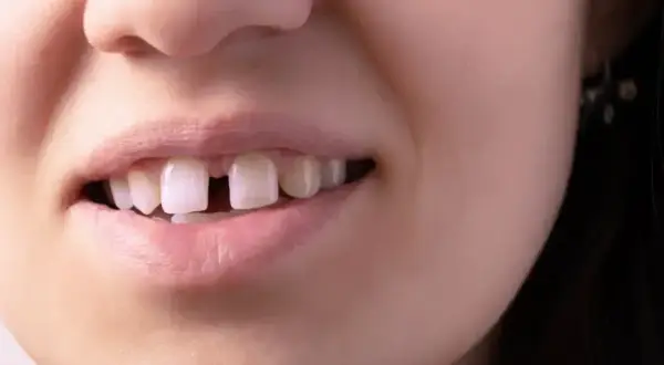 Diastema: Czy szpara między jedynkami to problem? Jak ją leczyć?