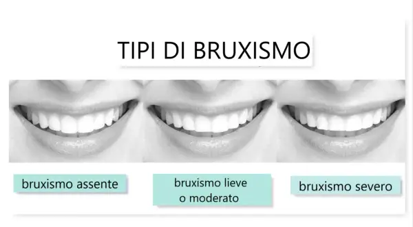 Tre immagini di sorrisi mostrano diversi gradi di bruxismo: assente, lieve/moderato e severo.