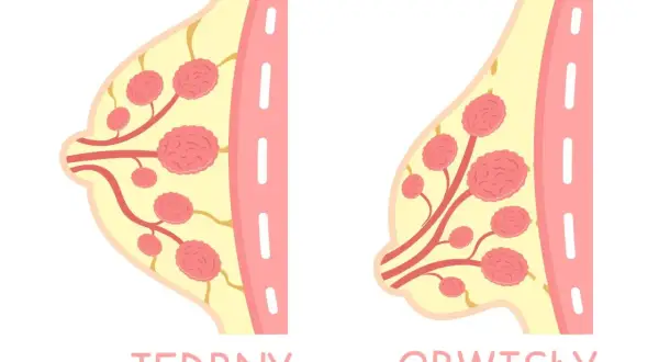 Ilustracja porównuje jędrny i obwisły biust, pokazując różnice w jego strukturze. Szukasz domowych sposobów na ujędrnienie biustu?