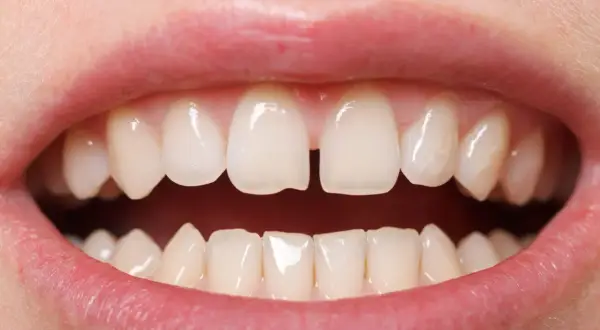 Szczelina między zębami, czyli diastema, jest widoczna na zbliżeniu uśmiechu.