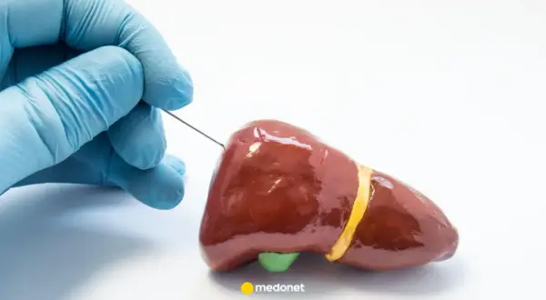 Rękawiczka w niebieskiej rękawiczce delikatnie wprowadza biopsja gruboigłowa igła do modelu wątroby.