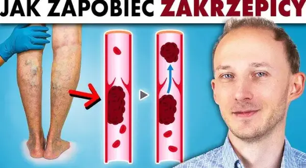 Zakrzepica jaki lekarz: jak uniknąć błędnych decyzji medycznych