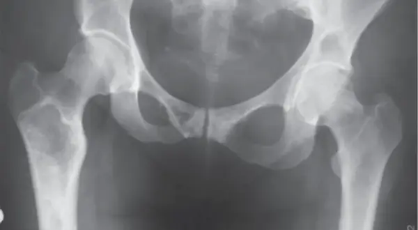 Czym jest ognisko osteolityczne? Przyczyny, objawy i diagnostyka zmian w kościach