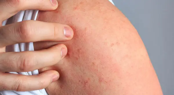 Alergia na tle nerwowym: objawy, jak rozpoznać i leczyć
