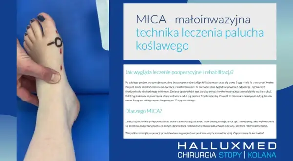 Jak zrobić opatrunek po operacji haluksa - uniknij błędów i bólu