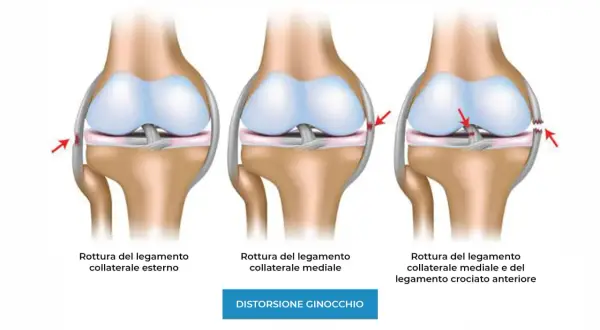 Illustrazione di ginocchia con lesioni ai legamenti: rottura collaterale esterno, mediale e combinata. Il dolore ai legamenti del ginocchio può variare.