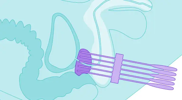 Illustration zeigt die Platzierung von Sonden für die Prostatakrebs-Strahlentherapie im Beckenbereich.