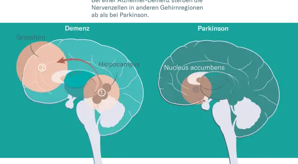 Gehirnschnitt zeigt Unterschiede bei Demenz und Parkinson. Bei Alzheimer-Demenz sterben Nervenzellen im Grosshirn und Hippocampus ab.