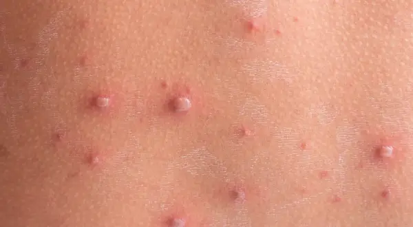 Skóra dziecka pokryta licznymi, czerwonymi krostkami i pęcherzykami, charakterystycznymi dla ospy wietrznej.