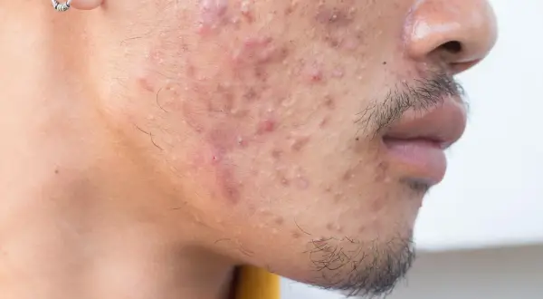 Visage d'un homme avec de l'acné. Une solution à base de rétinoïdes médicament pourrait aider à traiter ces imperfections.