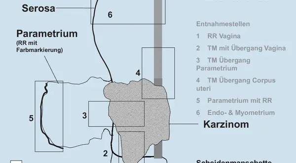 Schema zur Entnahme von Gewebeproben bei Zervixkarzinom. Markiert sind Serosa, Parametrium, Endometrium und Entnahmestellen.