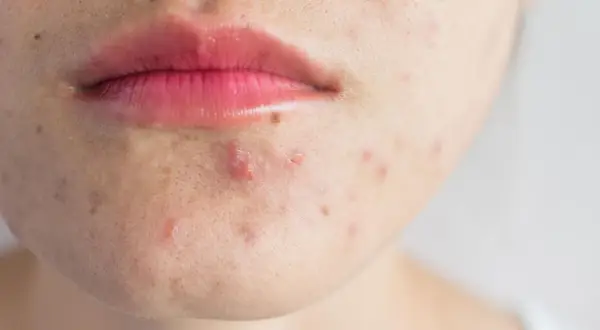 Nahaufnahme von Lippen und Kinn mit fettiger Haut und Pickeln.