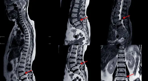 Badanie MRI kręgosłupa z widocznym uciskiem na korzenie nerwowe, wskazującym na rwa udowa. Czerwone strzałki podkreślają problem.