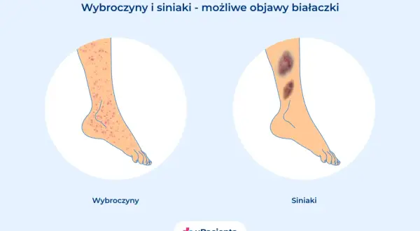 Wybroczyny i siniaki na nogach mogą być objawami białaczki u dzieci. Ilustracja pokazuje nogę z licznymi czerwonymi wybroczynami oraz nogę z ciemnymi siniakami.