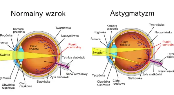 Czy da się wyleczyć astygmatyzm? Poznaj skuteczne metody leczenia