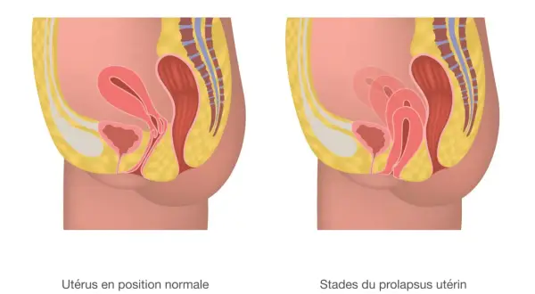Comparaison d'un utérus en position normale et d'un prolapsus utérin stade 4, où l'organe descend significativement.