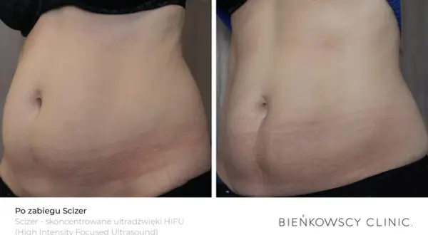 Wiotka skóra po odchudzaniu? Ujędrnij brzuch dietą, ćwiczeniami, pielęgnacją